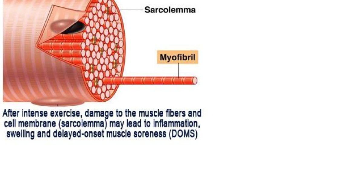 DelayedOnset Muscle Soreness (DOMS) ⋆ Santa Barbara Deep Tissue