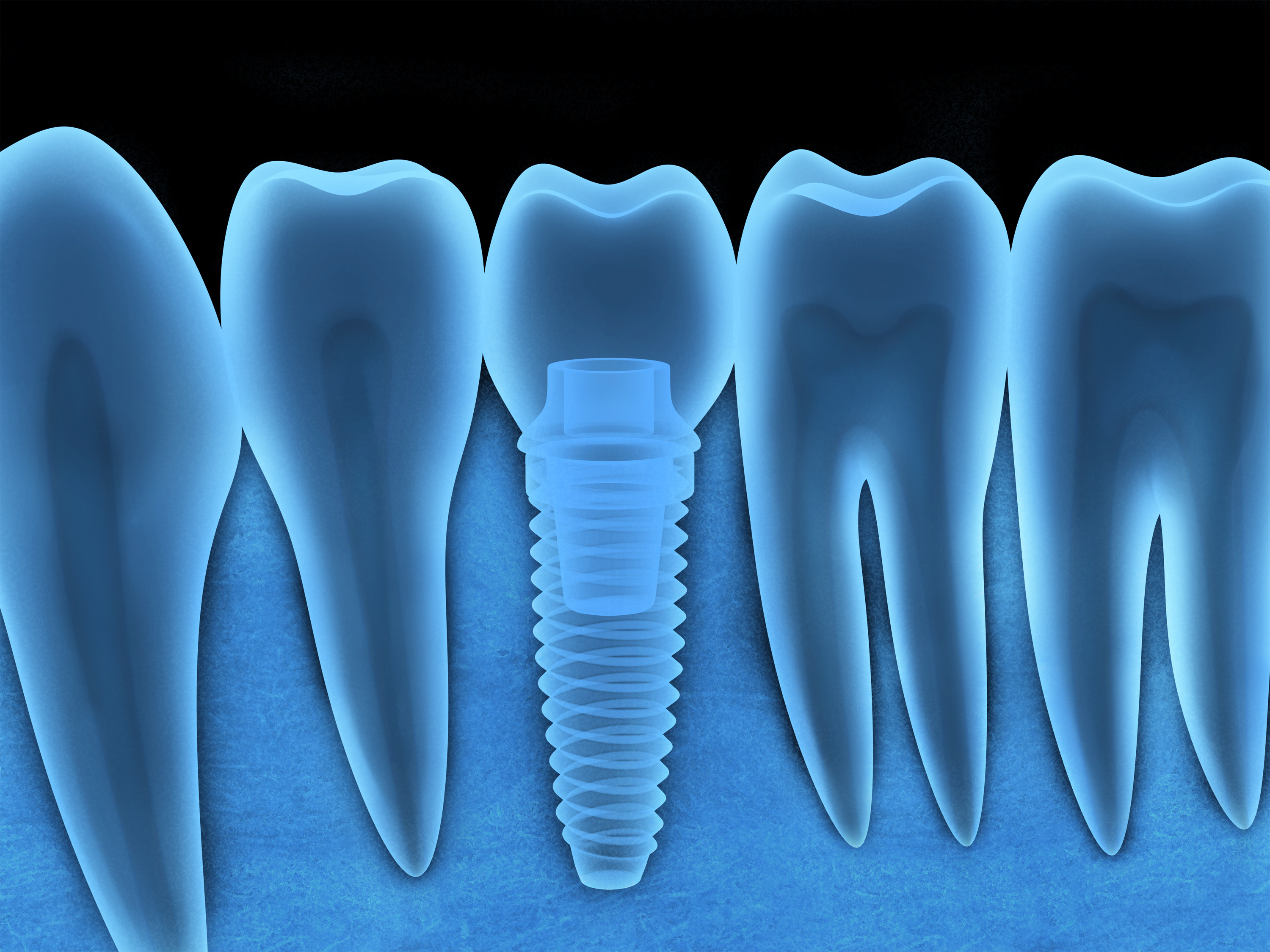 Overseeing Dental Implants With Technology Santa Rosa, CA
