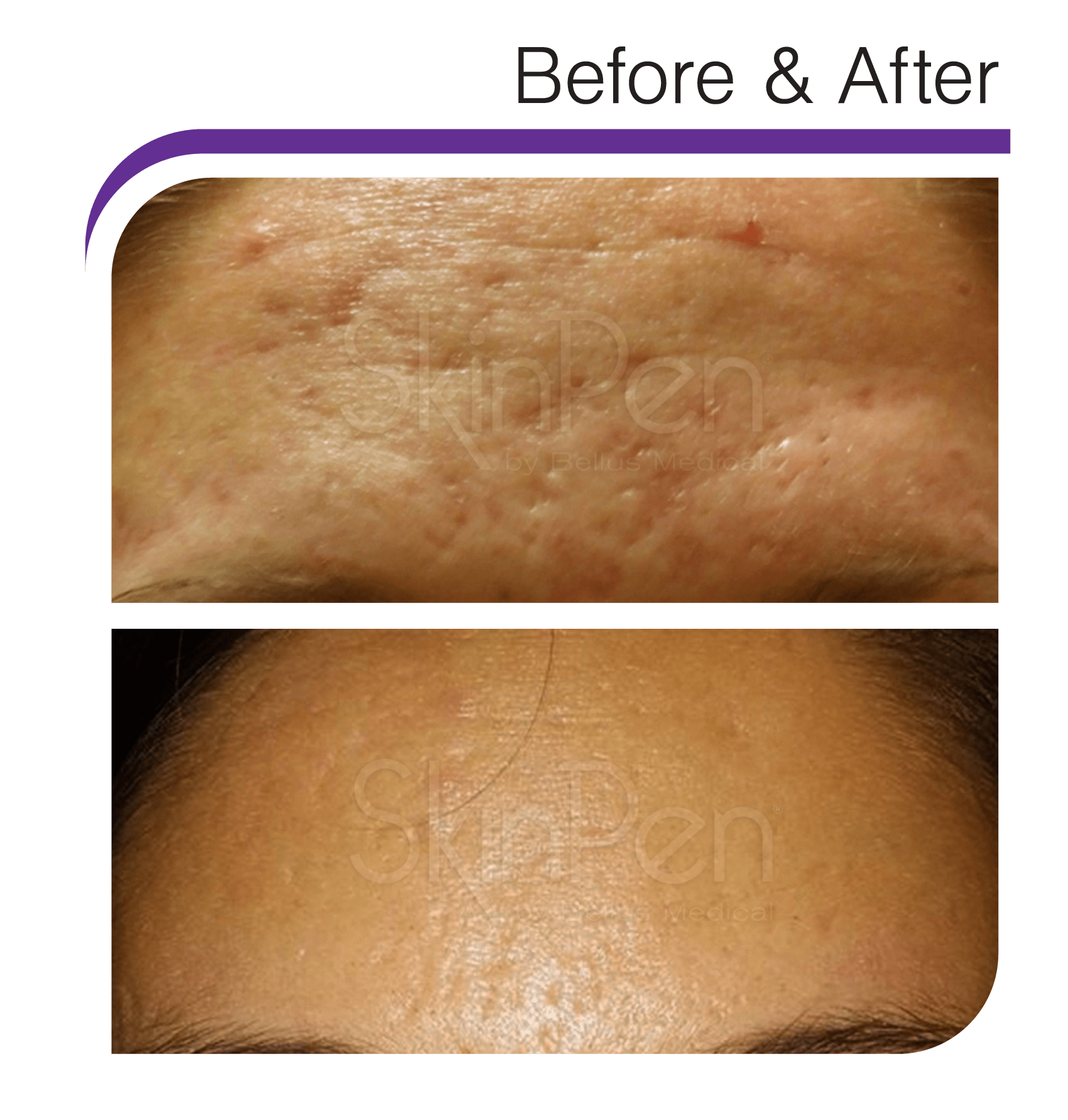 Best Treatments To Eliminate Acne Scarring Sante Med Spa