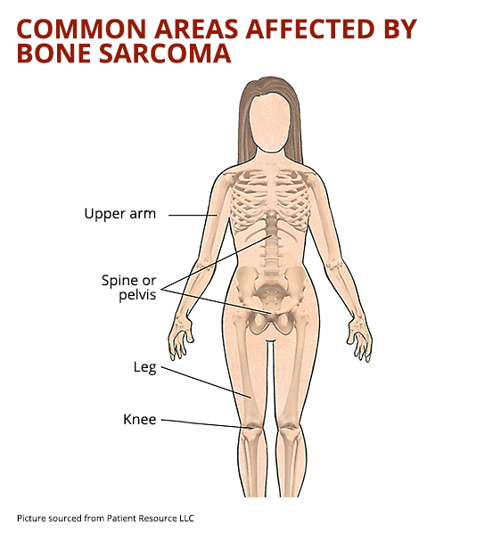 Bone Sarcoma