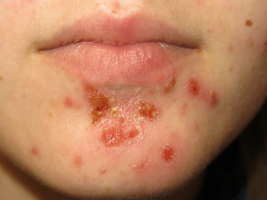 Impetigo saudedia