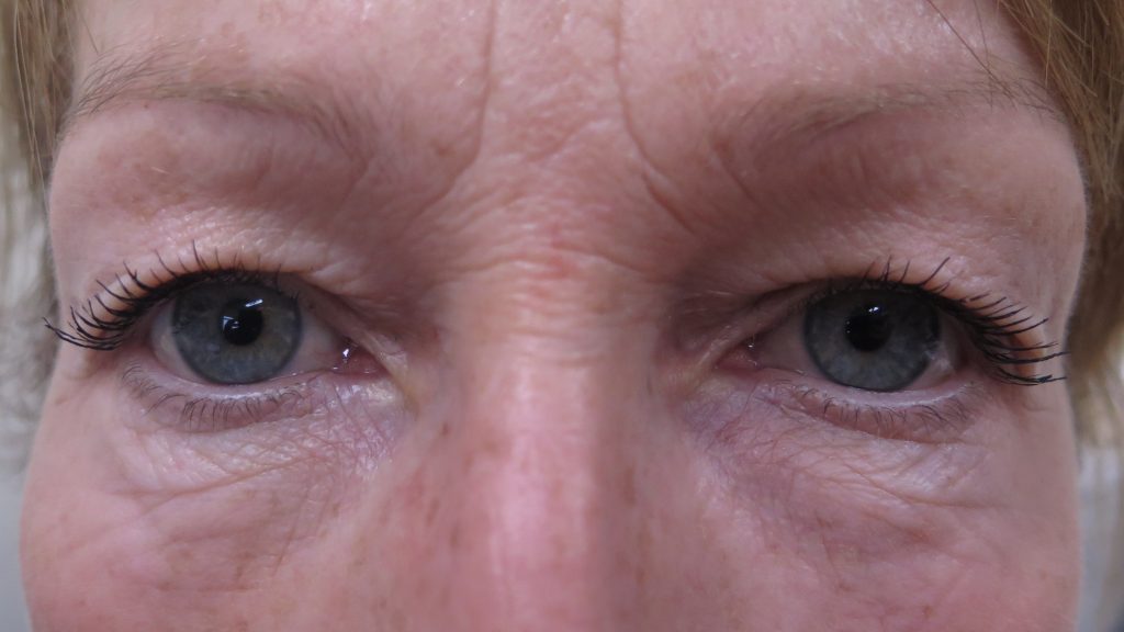 Excess Eyelid Skin and/or Fat (Dermatochalasis and Blepharoplasty