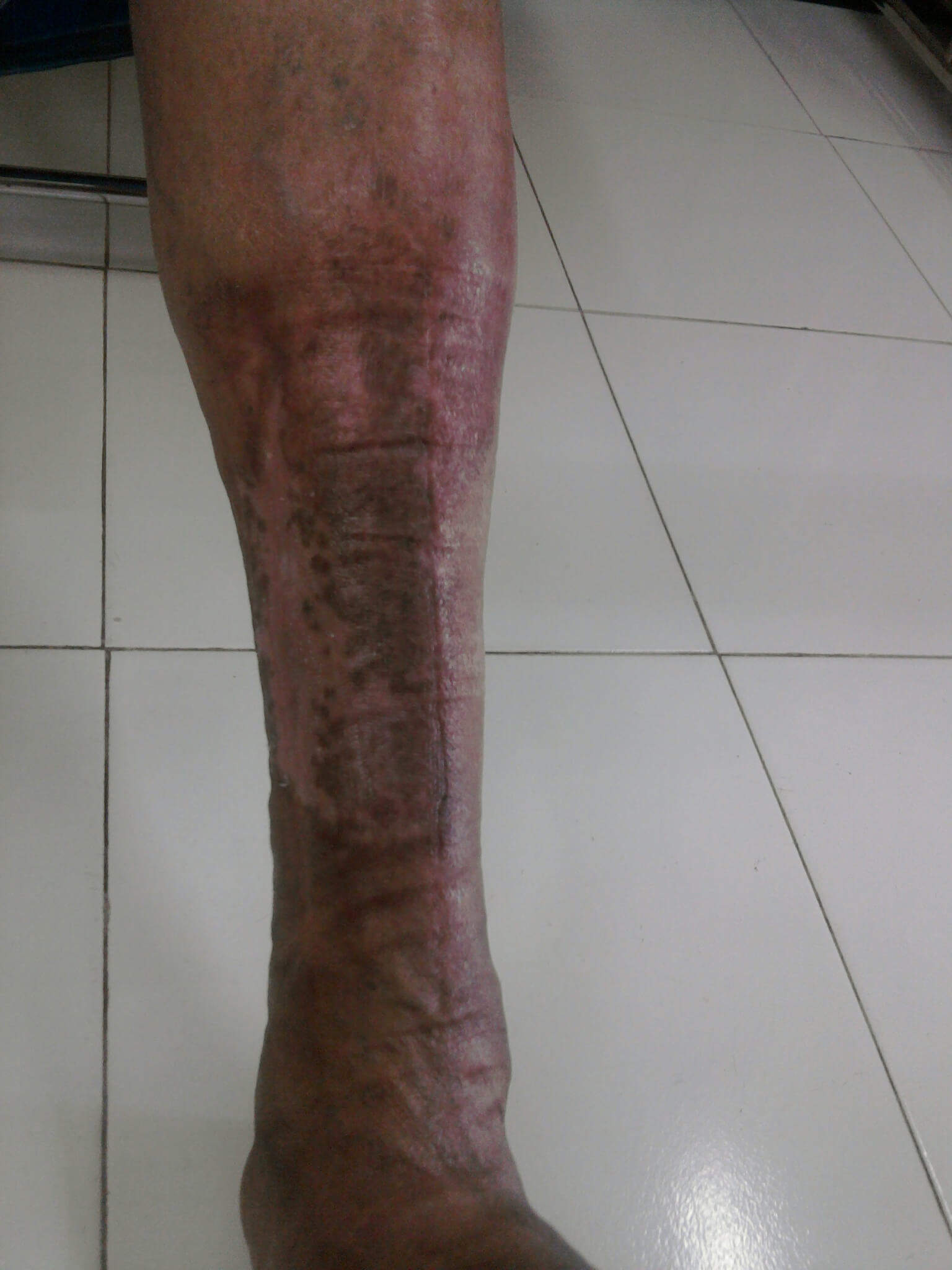 CELLULITIS Diabetic Foot Clinic
