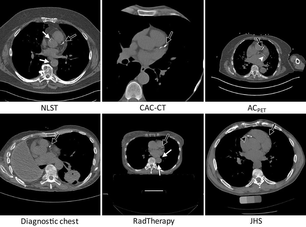 Coronary Calcium Scan Save Your Heart In Mexico