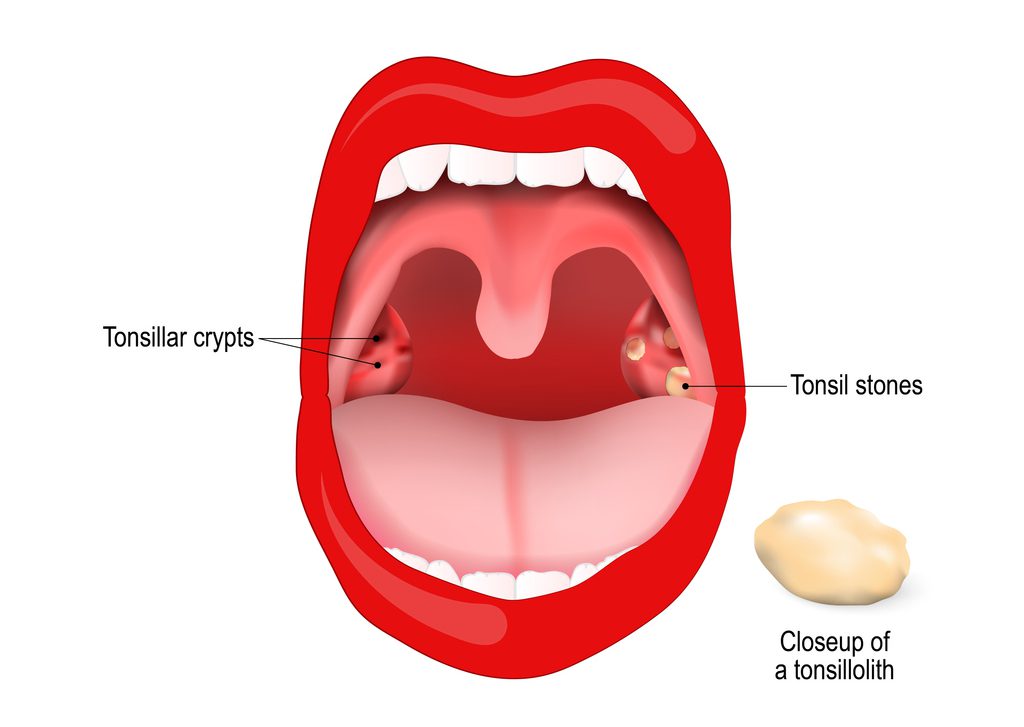Removing Tonsil Stones? Top 10 Best Products (2023)