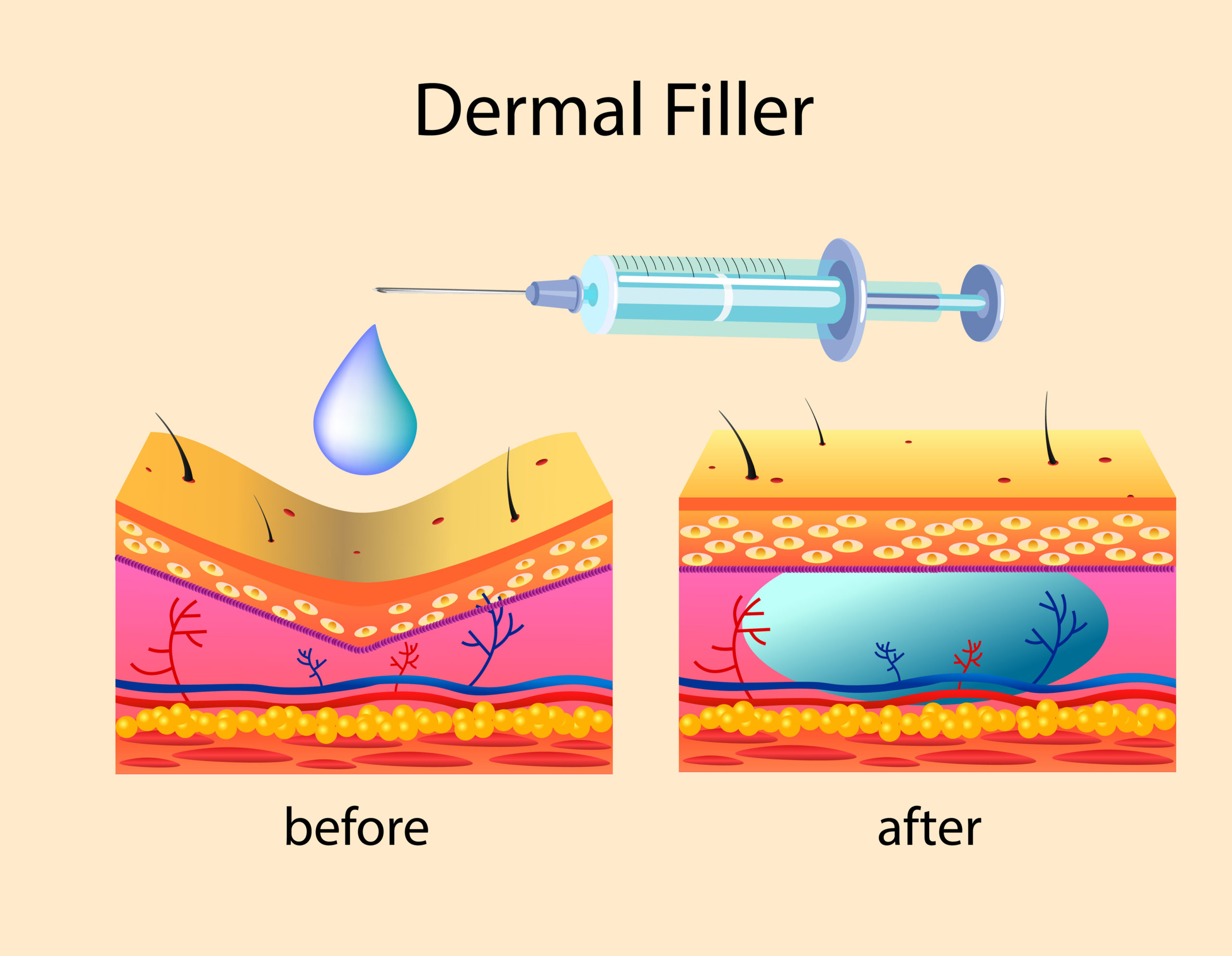How do Dermal Filler Work on Wrinkles?