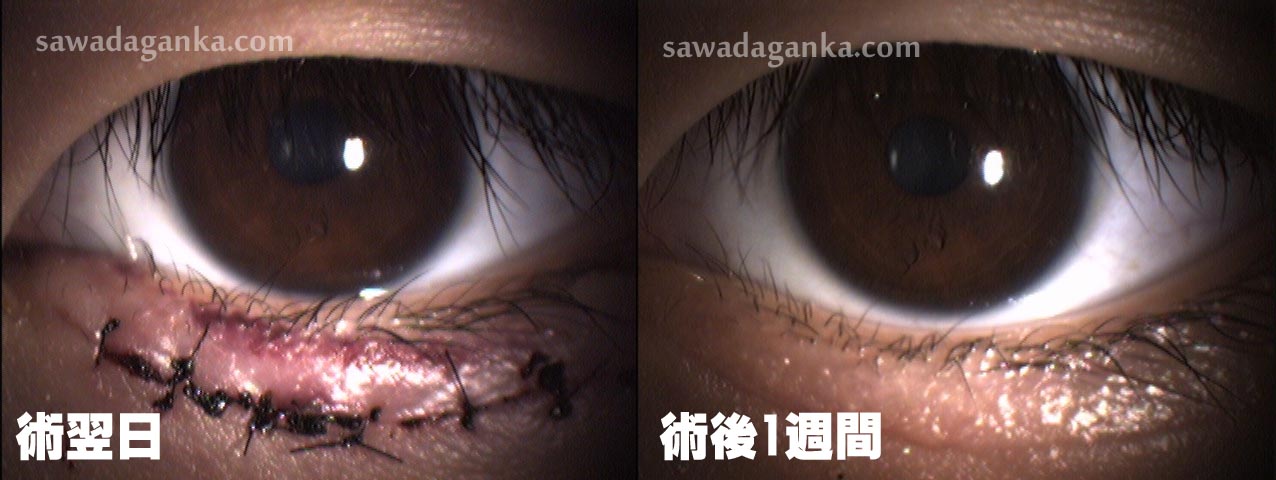 下眼瞼内反症 なかもず駅前の さわだ眼科