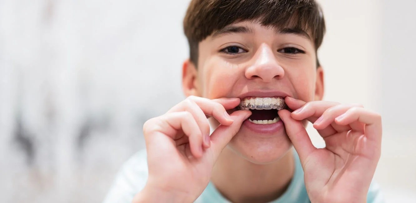 How long will I have to wear Invisalign or braces? Saxe Orthodontics