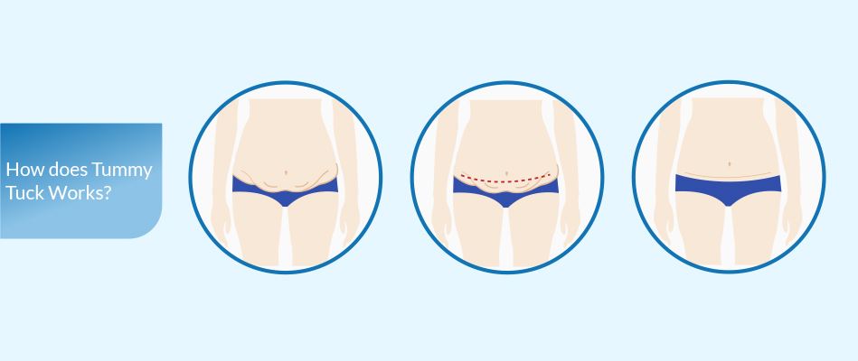 Tummy Tuck