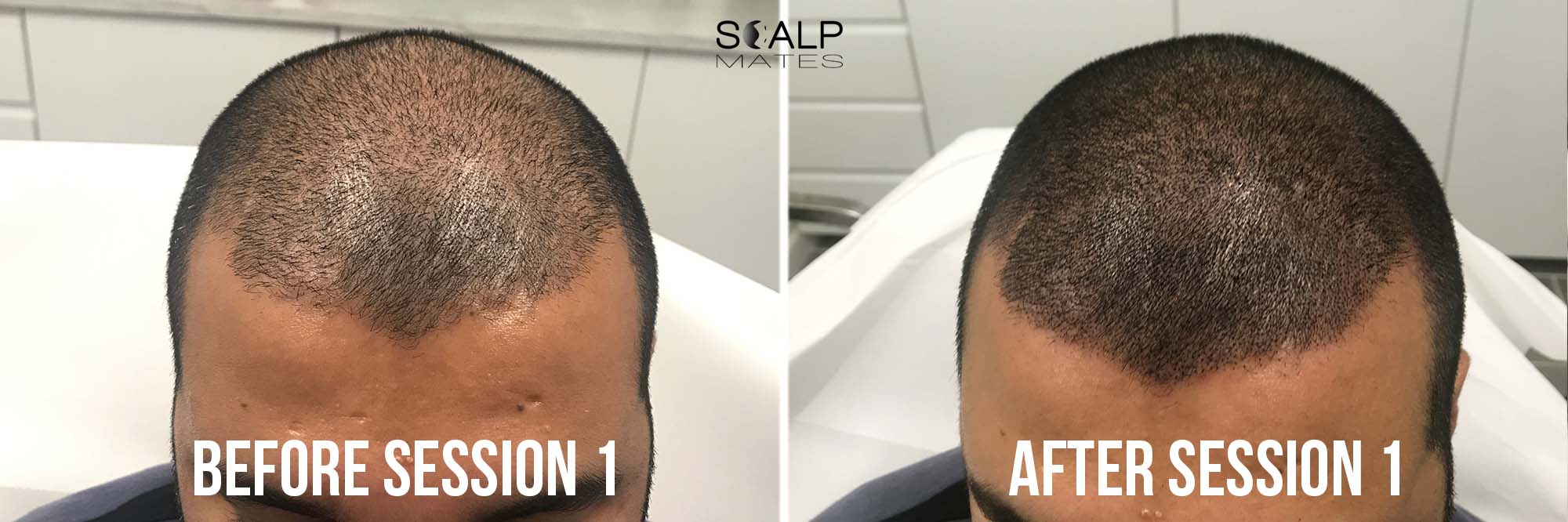 Scalp Micropigmentation SMP for Long Hair in Birmingham UK Results