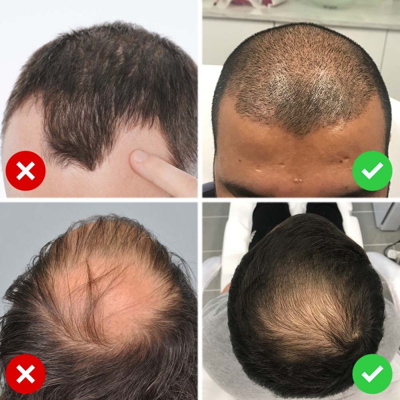 Scalp Micropigmentation SMP for Long Hair in Birmingham UK Results