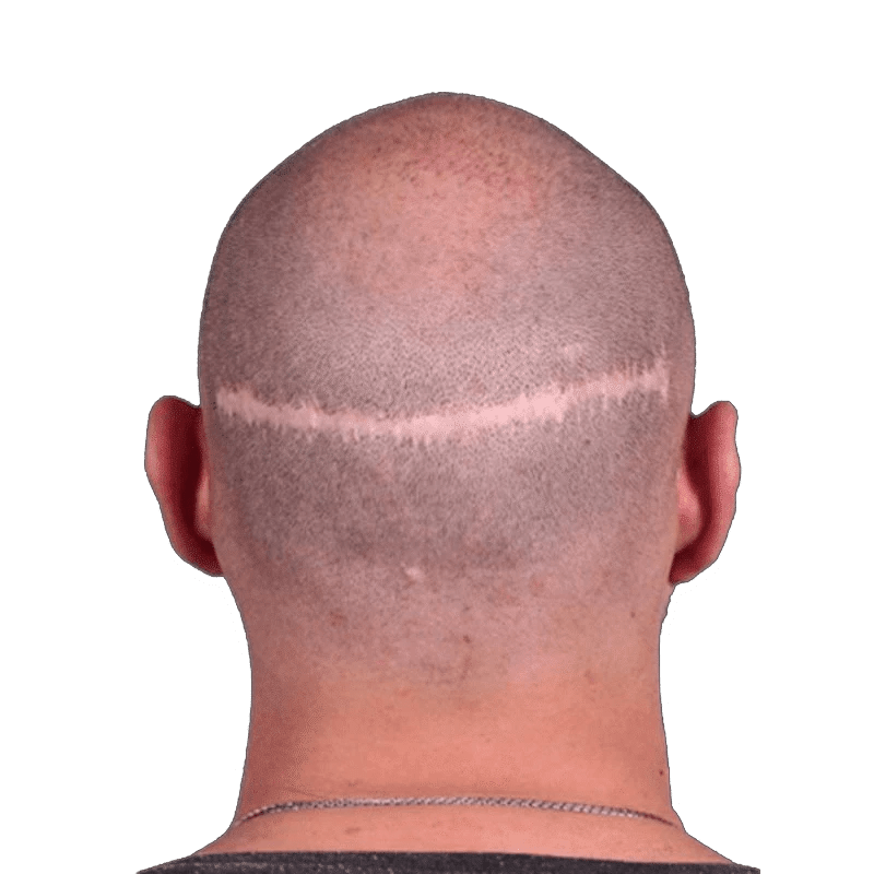 Scar Micropigmentation Camouflage & Hair Tattoo SCALPS USA