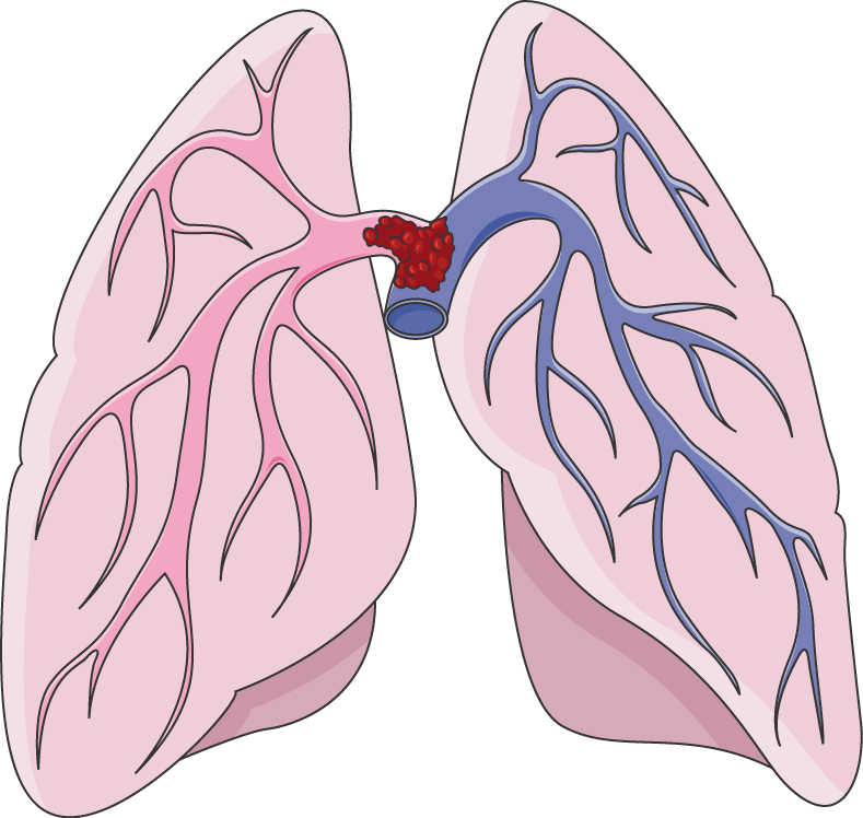 Could a Yellow Bruise Behind the Knee Be a Blood Clot? » Scary Symptoms