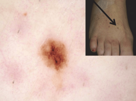 Why Is Melanoma Survival Rate Higher for Stage 0 vs. Stage 1? — Scary