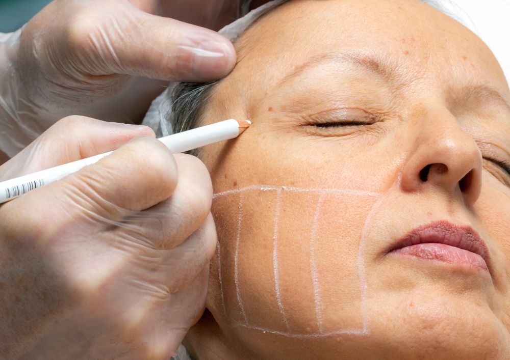 Hifu Treatment Near Me Simcoe Cosmetic Clinic