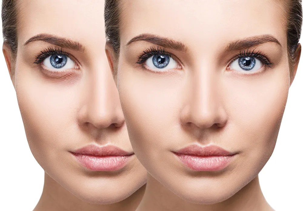 Everything About Eye Fillers