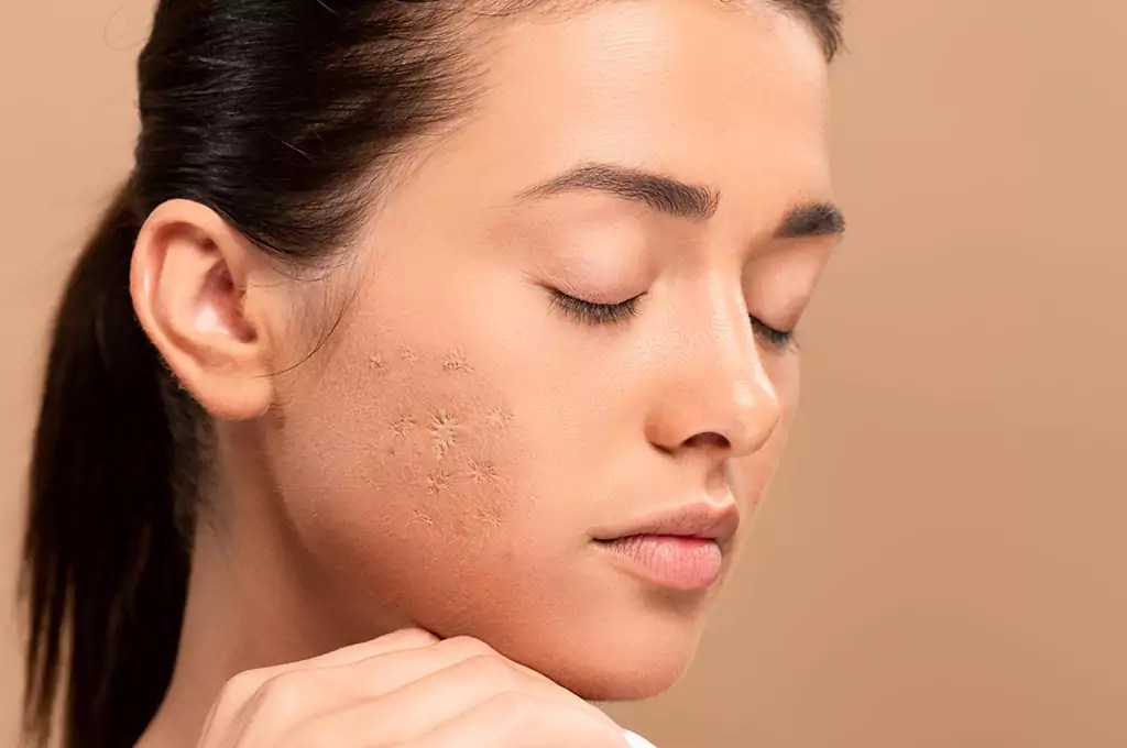 The Ultimate Guide to Facial Scars Types, Causes, and Treatment