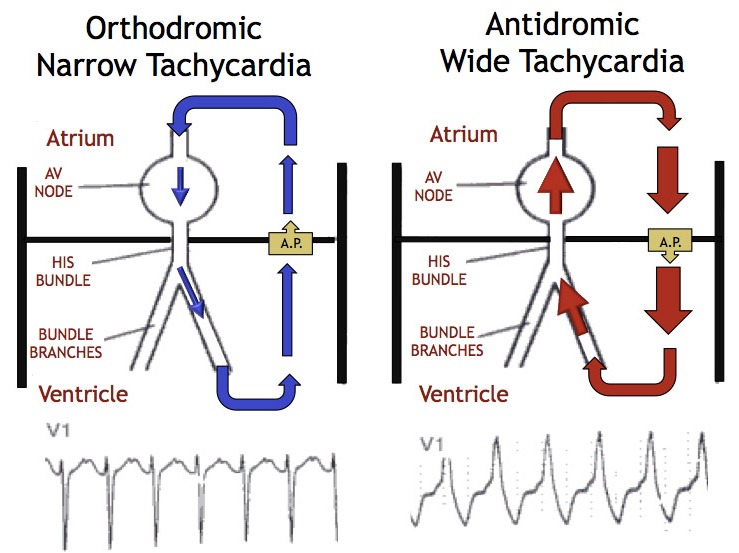 wolff parkinson white orthodromic에 대한 이미지 검색결과