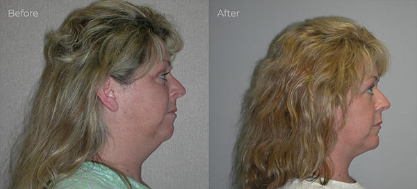 What to Expect During Power Assisted Liposuction Recovery