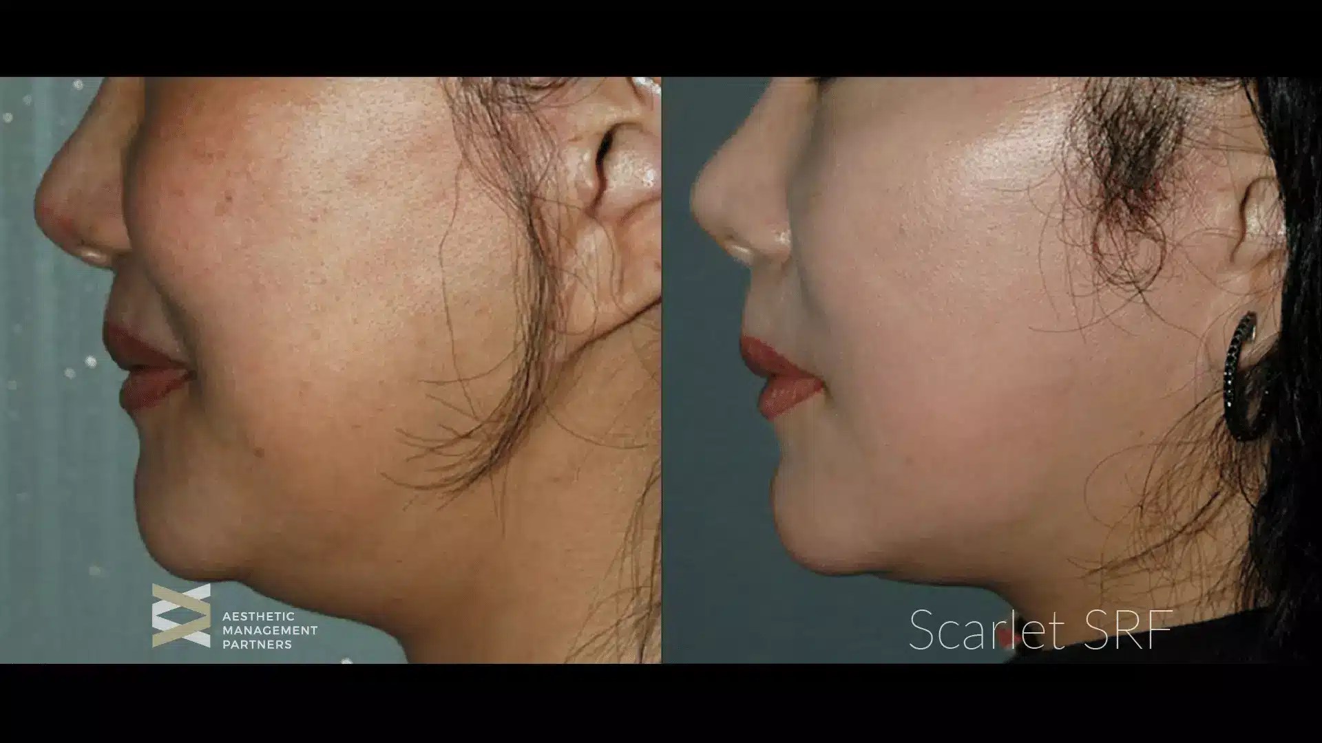 Scarlet SRF How Radiofrequency Energy Can Transform Your Skin Scherl MD