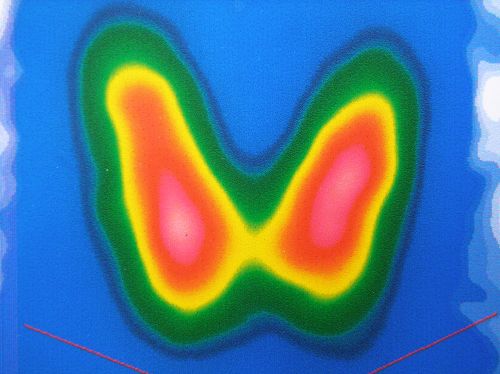 Das technetium wird in die vene gespritzt und reichert sich gezielt in der schilddrüse an. Szintigramm der Schilddrüse | Schilddrüsenunterfunktion ...