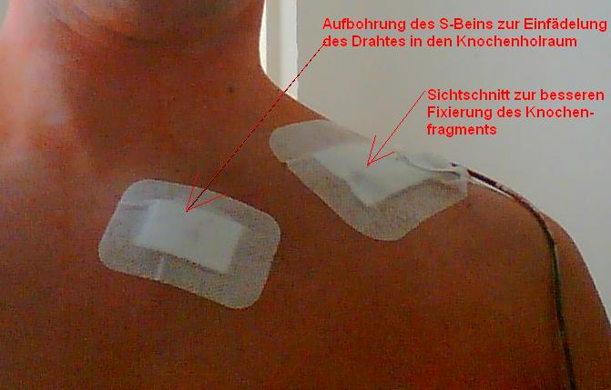 Schluesselbeinbruch (Claviculafraktur) Tipps und Links