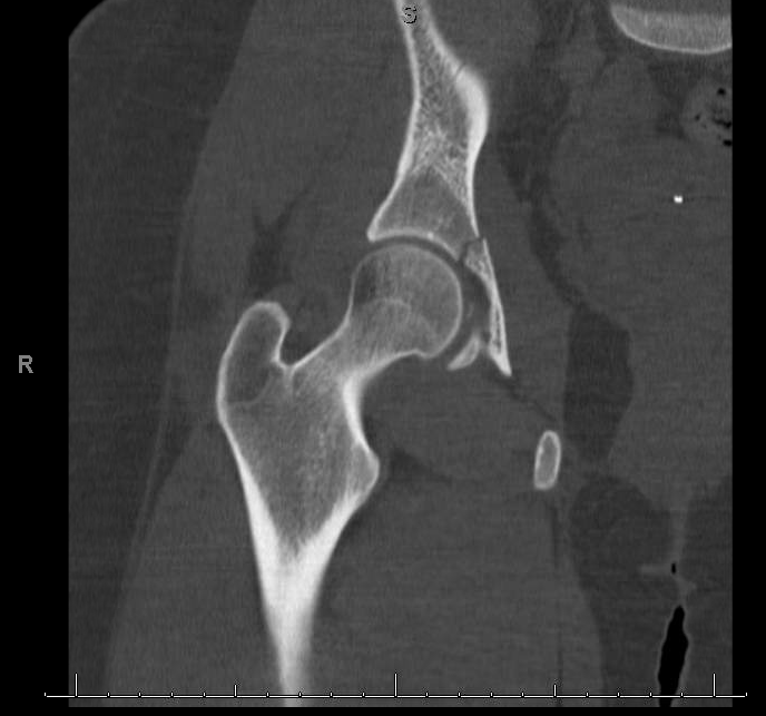 Hip Pain and Negative Plain Films Curbside Consult