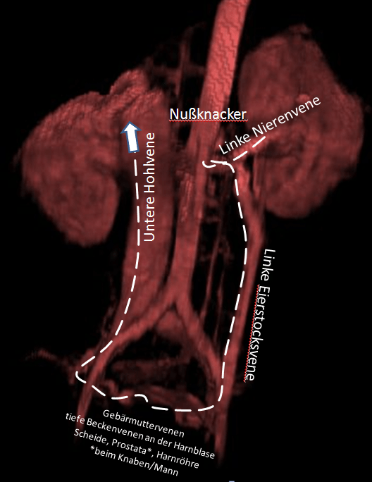 痛みがとれない時にどうするか？ | 中京病院 症状コントロールガイド 骨盤うっ血症候群（骨盤内臓器のうっ血