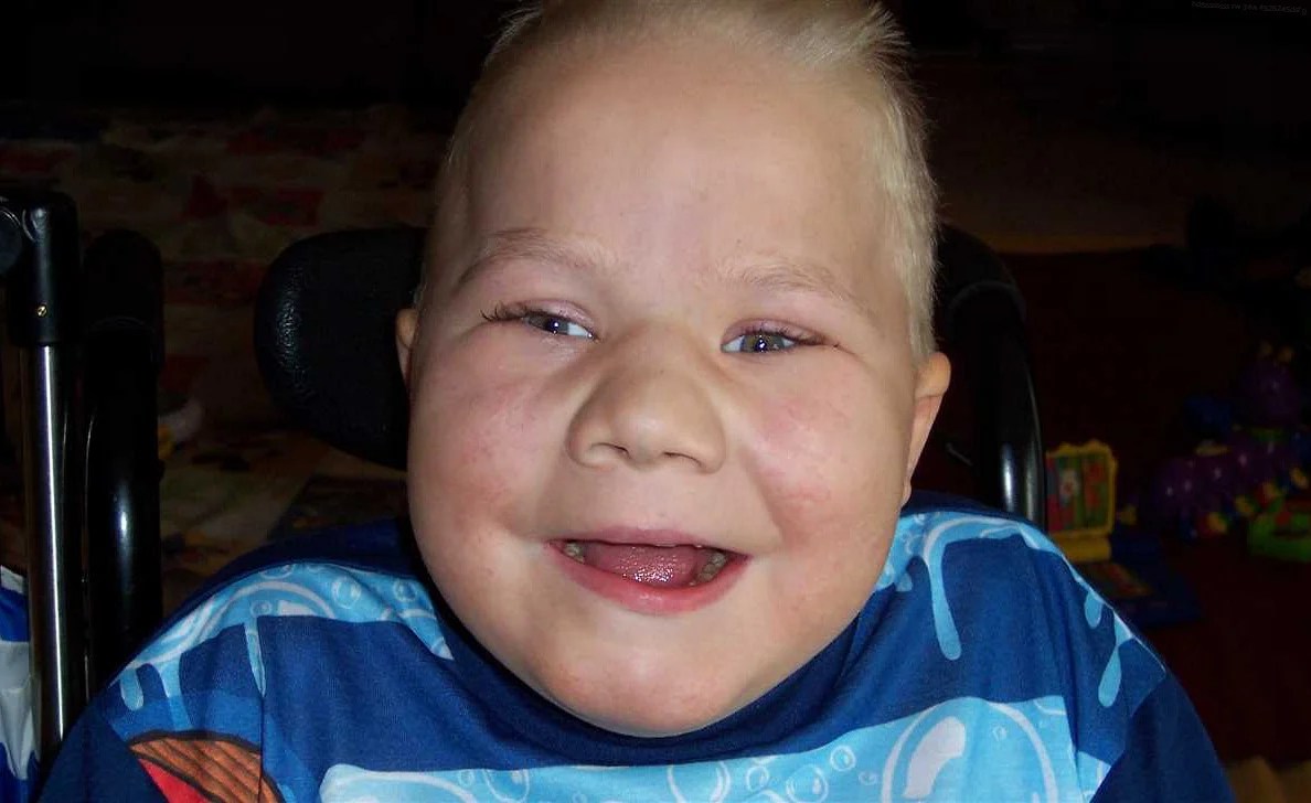 Understanding Trisomy 13 Causes, Symptoms, and Treatments site