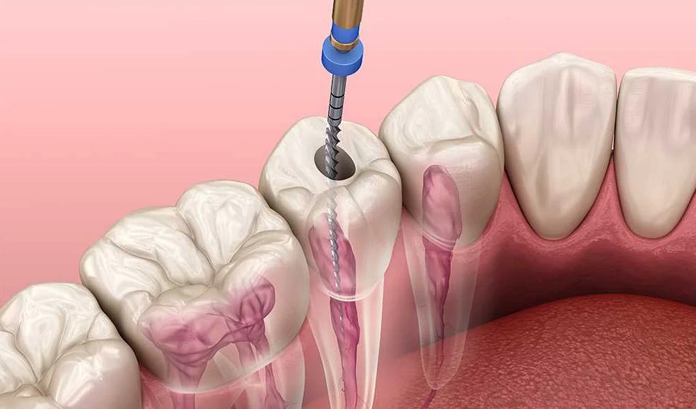 Why Does a Tooth with a Removed Nerve Hurt and How to Alleviate the Pain