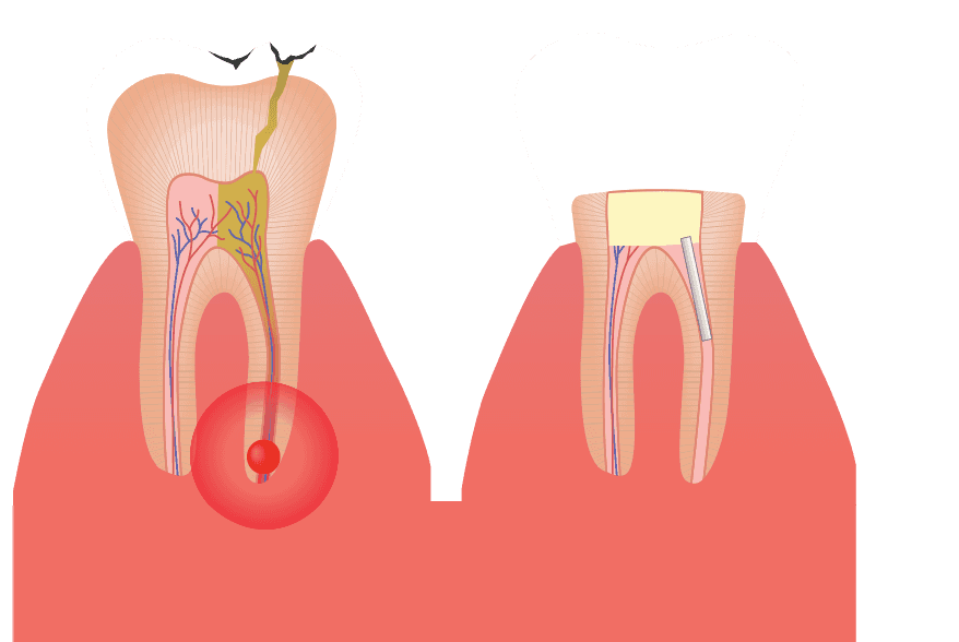 Endodontics Tucson Schumer Dental, PC
