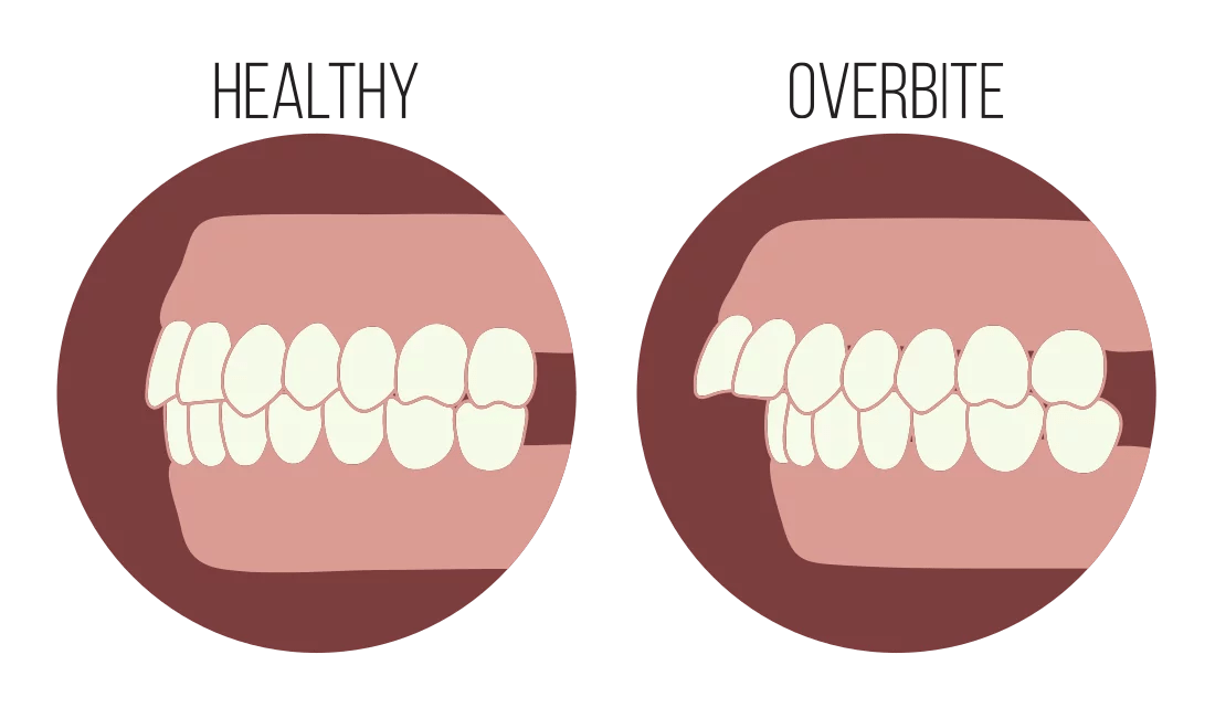 Overbite Tucson Schumer Dental, PC