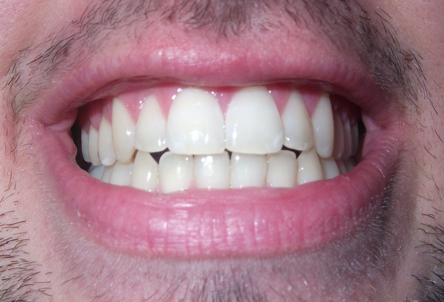 Do You Need Daily Treatment to Repair Damaged Enamel? ScienceBased