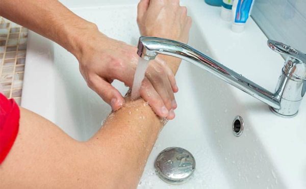 To best treat a burn, first cool with running water, study shows