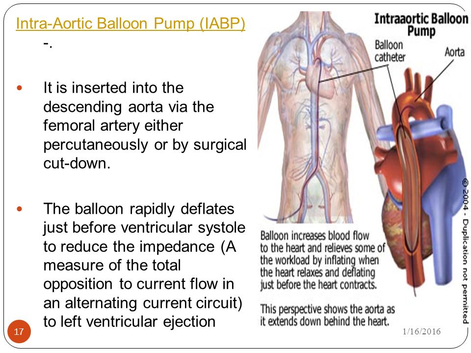 Intra-Aortic+Balloon+Pump+(IABP)+-. – SciFi