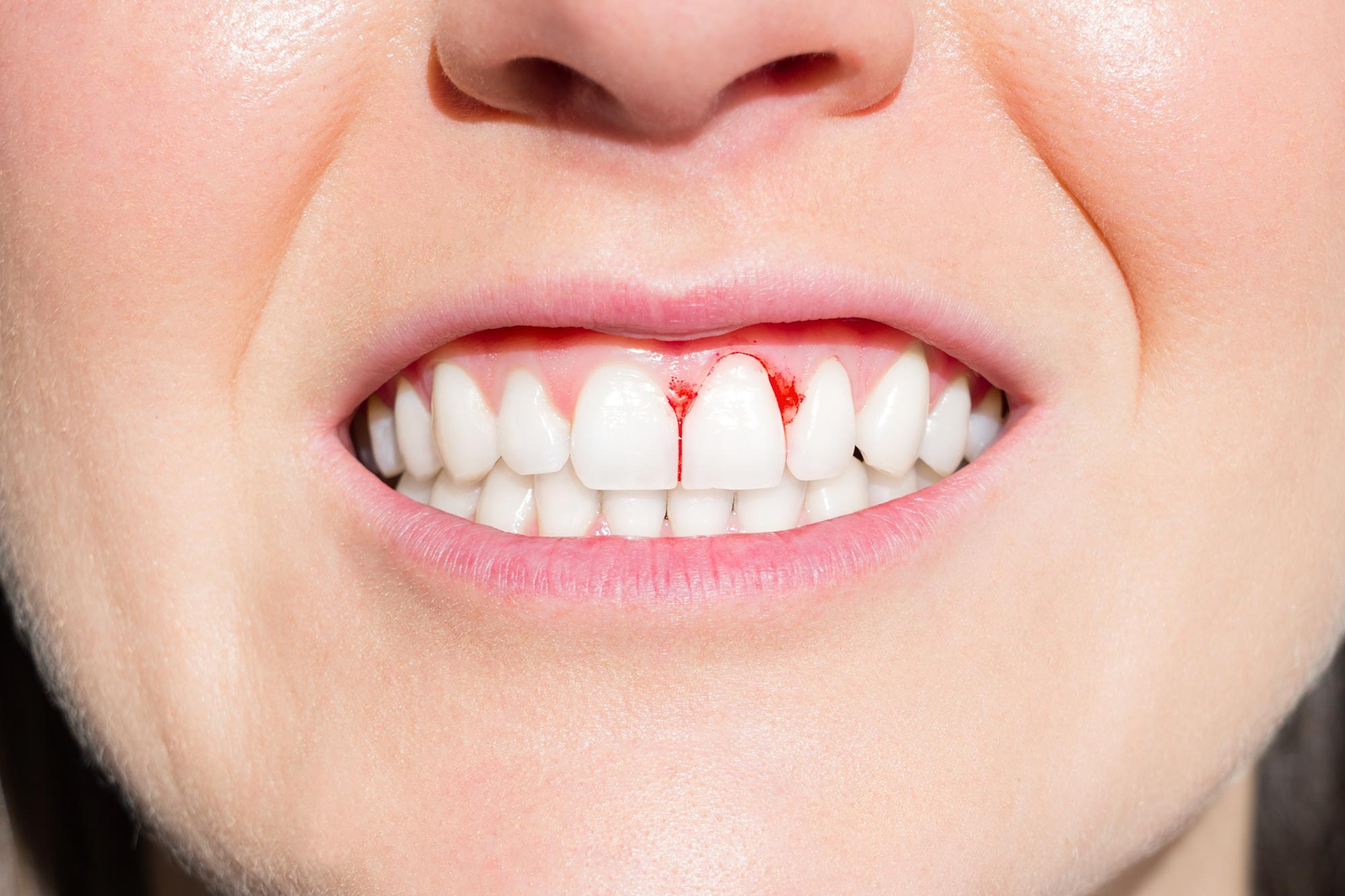 Bleeding Gums Can Be a Sign You Need More Vitamin C