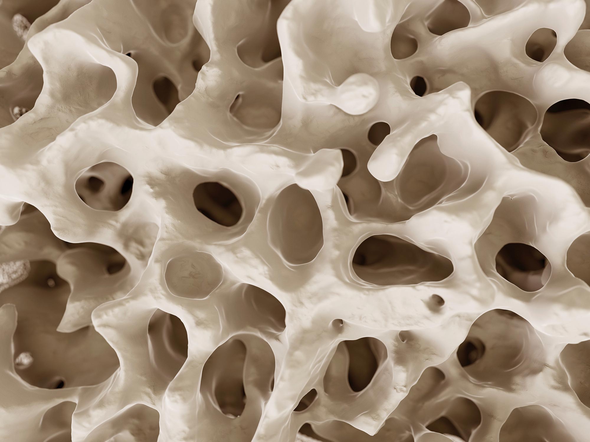 WeightLoss Surgery’s Hidden Hazard Weakened Bones in Teens and Young