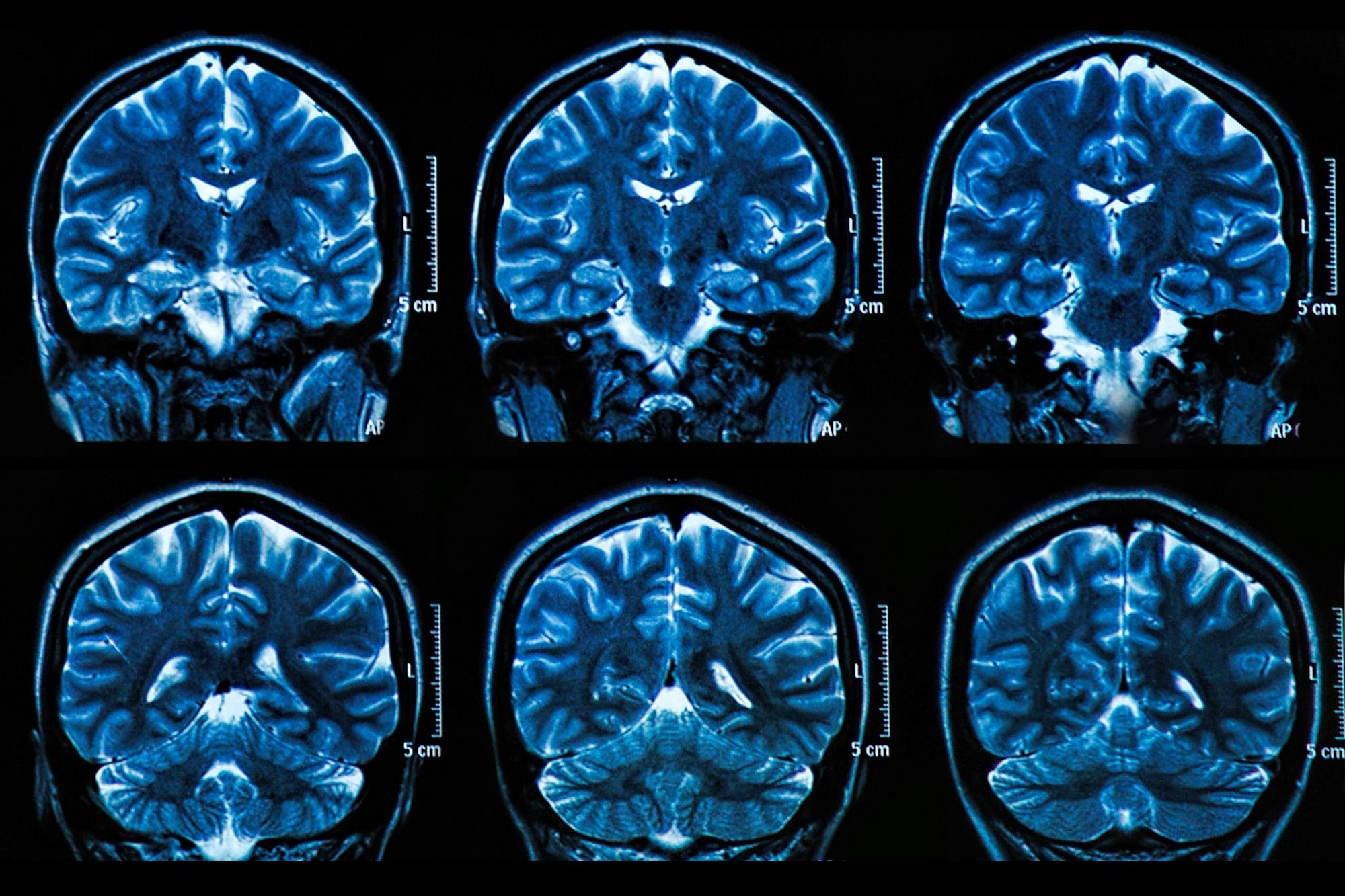 Unlocking the Secrets Behind AgeRelated Memory Loss