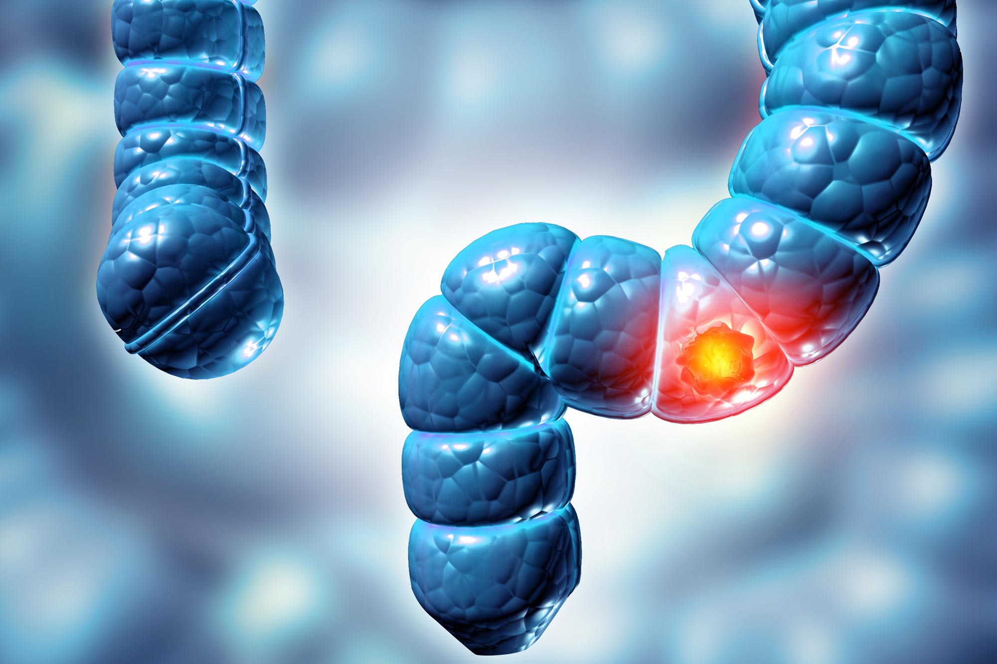 Scientists Discover Hidden Virus Linked to Colorectal Cancer