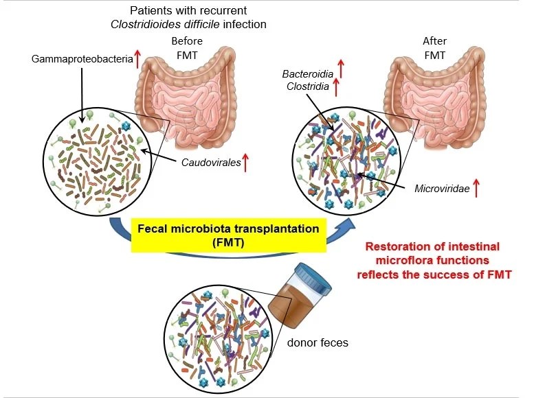 Pooping Out Miracles Successful Mechanism Behind Fecal Microbiota