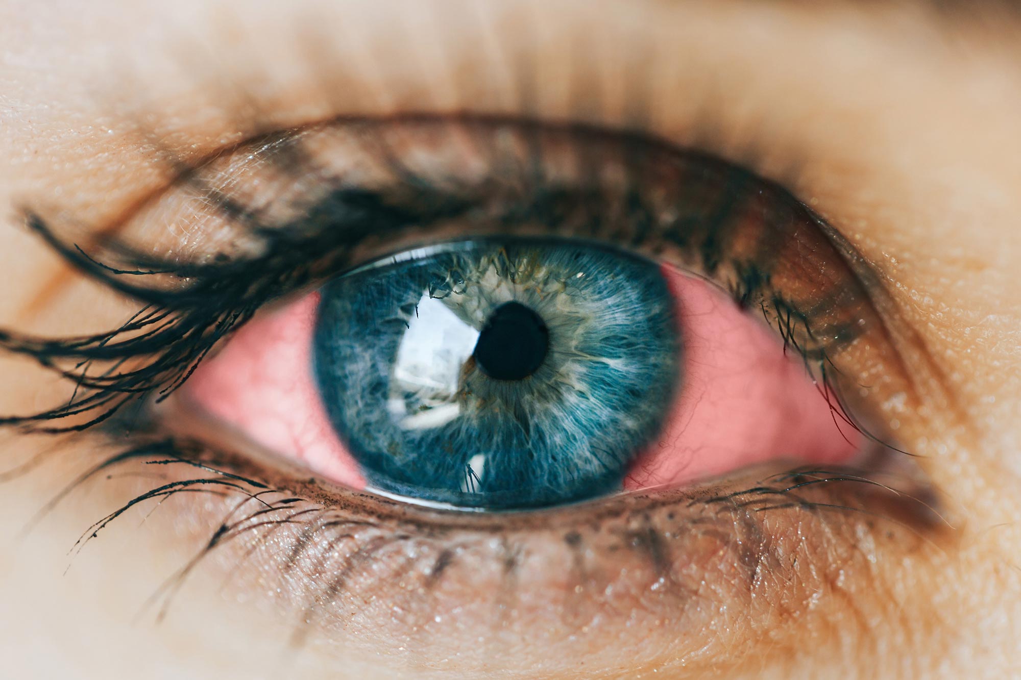 Unraveling the Mystery of Eye Damage in Alzheimer’s Disease Patients