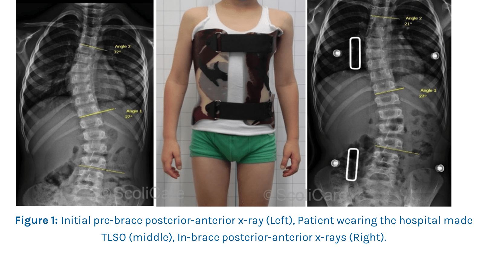 Case Study Inbrace correction with a custom scoliosis brace ScoliBrace