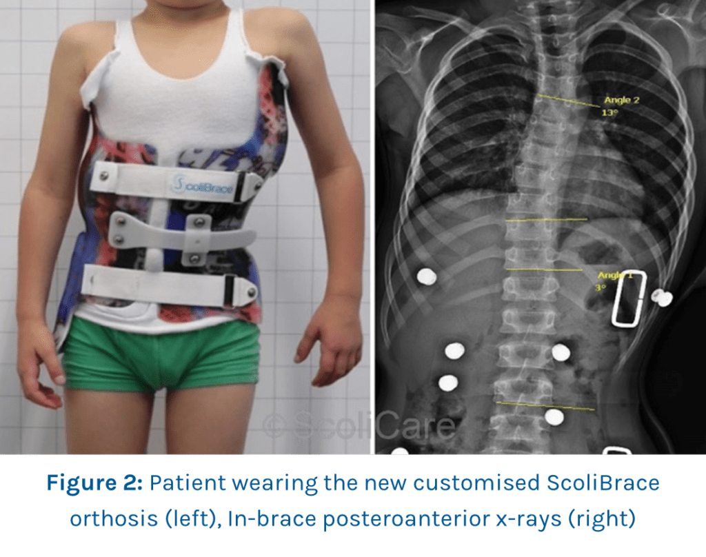 Case Study Inbrace correction with a custom scoliosis brace ScoliBrace