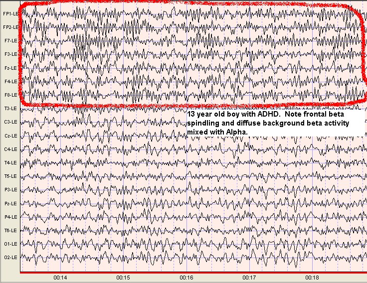 Beta Waves Scottsdale Neurofeedback Institute, AZ