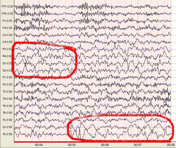 Delta Waves Scottsdale Neurofeedback Institute, AZ