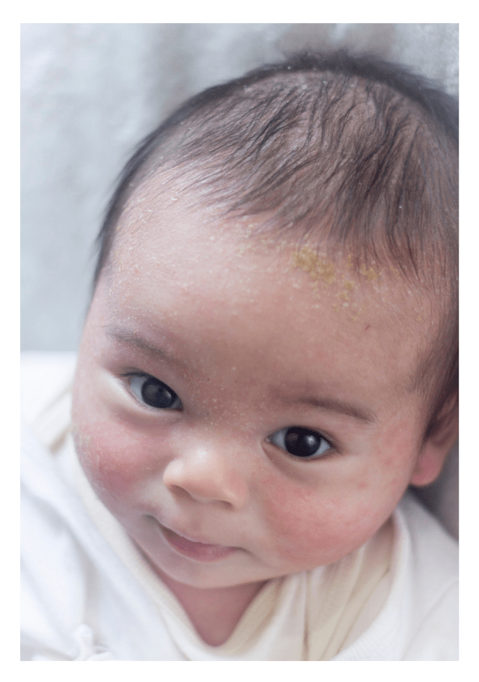 Cradle Cap The ScratchSleeves Guide