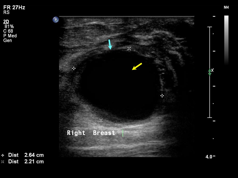 Atlas of breast cancer early detection