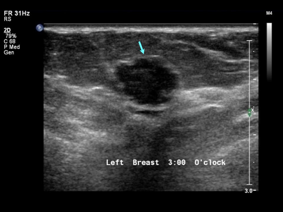 Atlas of breast cancer early detection