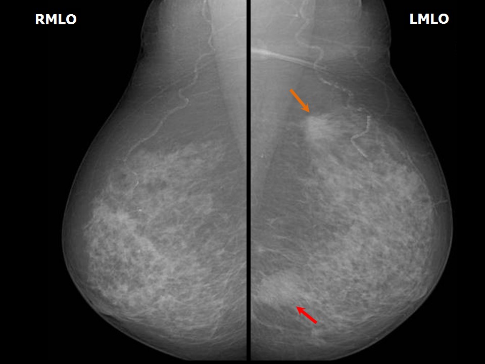 Atlas of breast cancer early detection
