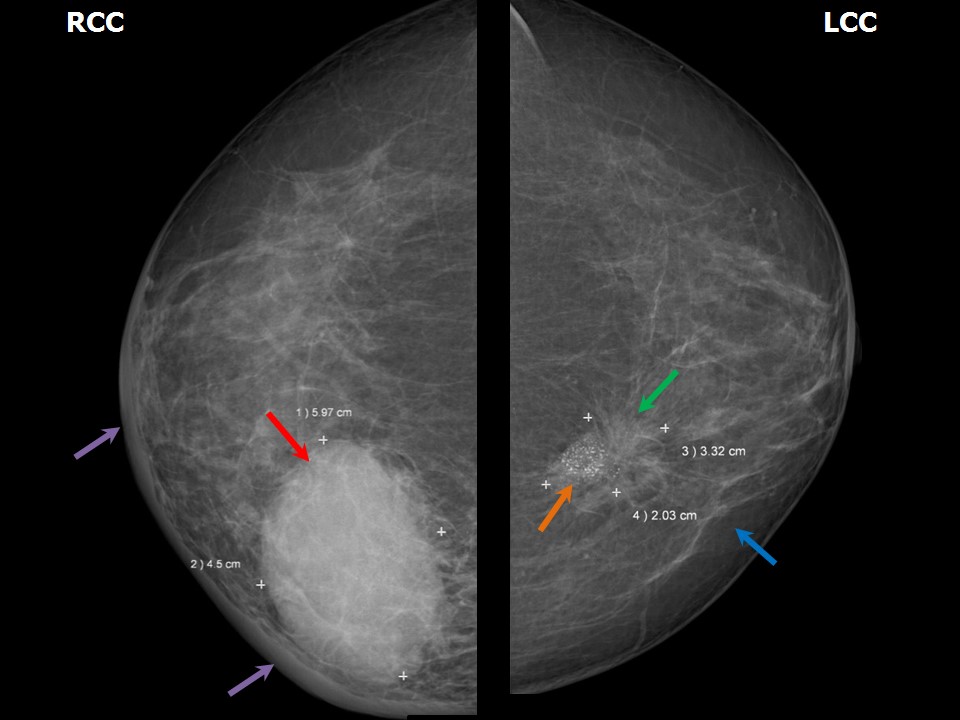 Atlas of breast cancer early detection